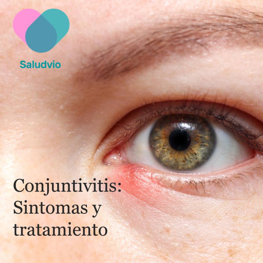 Qué Es La Conjuntivitis Y Como Se Puede Tratar Saludvio 5948